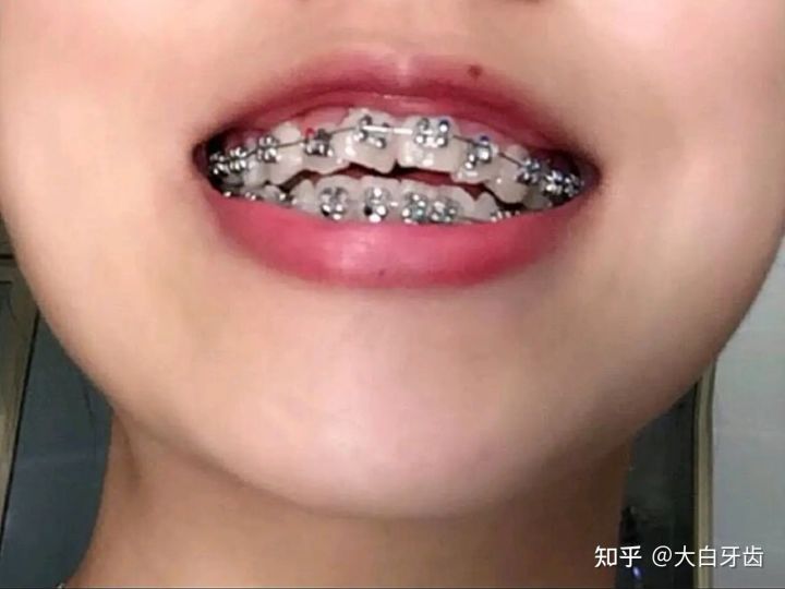 2022年成都十大牙齒矯正醫(yī)院排名,成都牙齒矯正哪里性?xún)r(jià)比最高?成都牙齒矯正價(jià)格表!(圖3) 2022年成都十大牙齒矯正醫(yī)院排名,成都牙齒矯正哪里性?xún)r(jià)比最高?成都牙齒矯正價(jià)格表!(圖3)